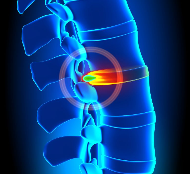 X-Ray of a spine with a herniated disc