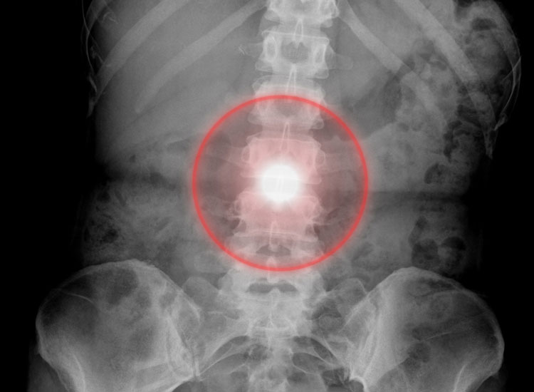 X-Ray of spine