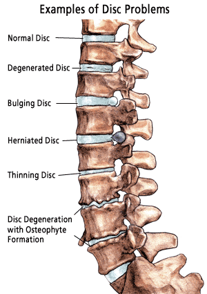 Spinal Correction